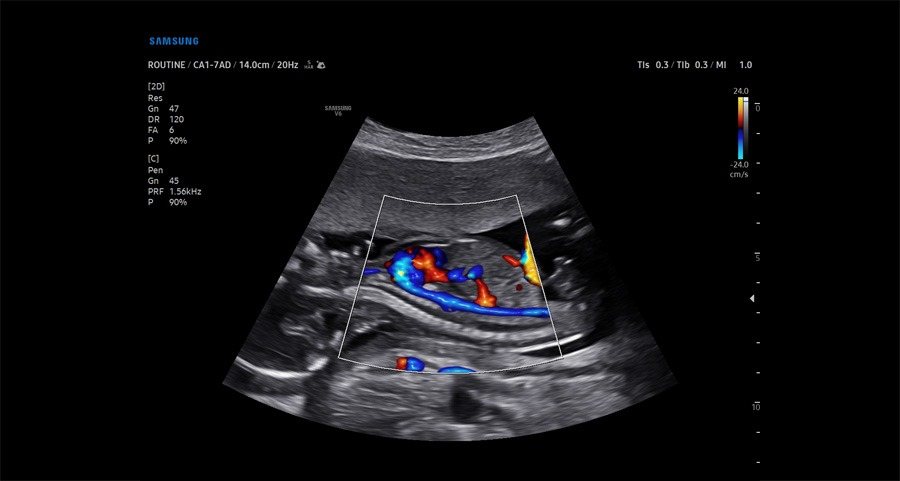 Samsung Medison V6: Сосуды плода, LumiFlow