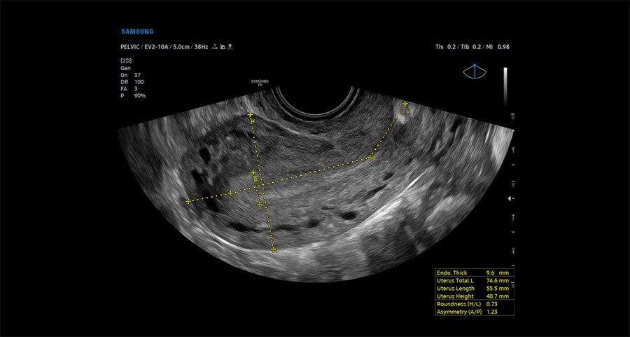 Samsung Medison V6: Матка, трансвагинальное исследование, UterineAssist